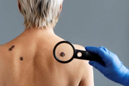 Câncer de pele: método ABCDE ajuda a detectar doença precocemente