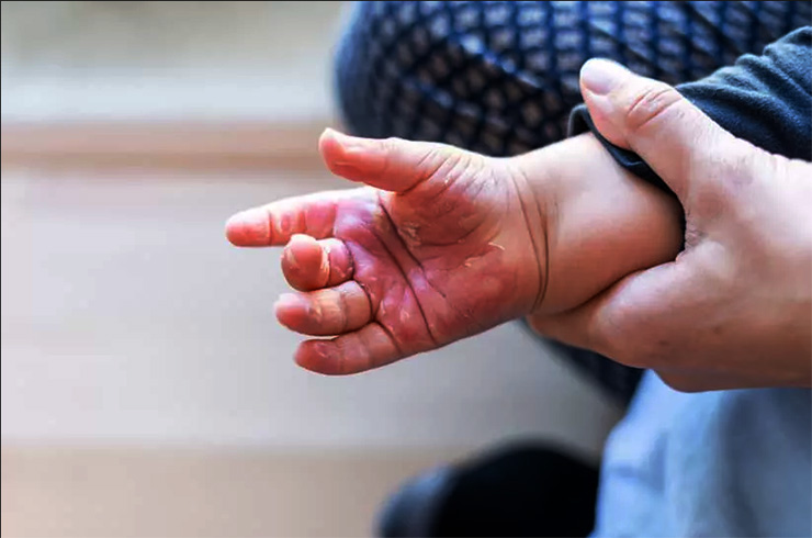 Goiás registra o 3º maior número de internações por queimaduras infantis no país