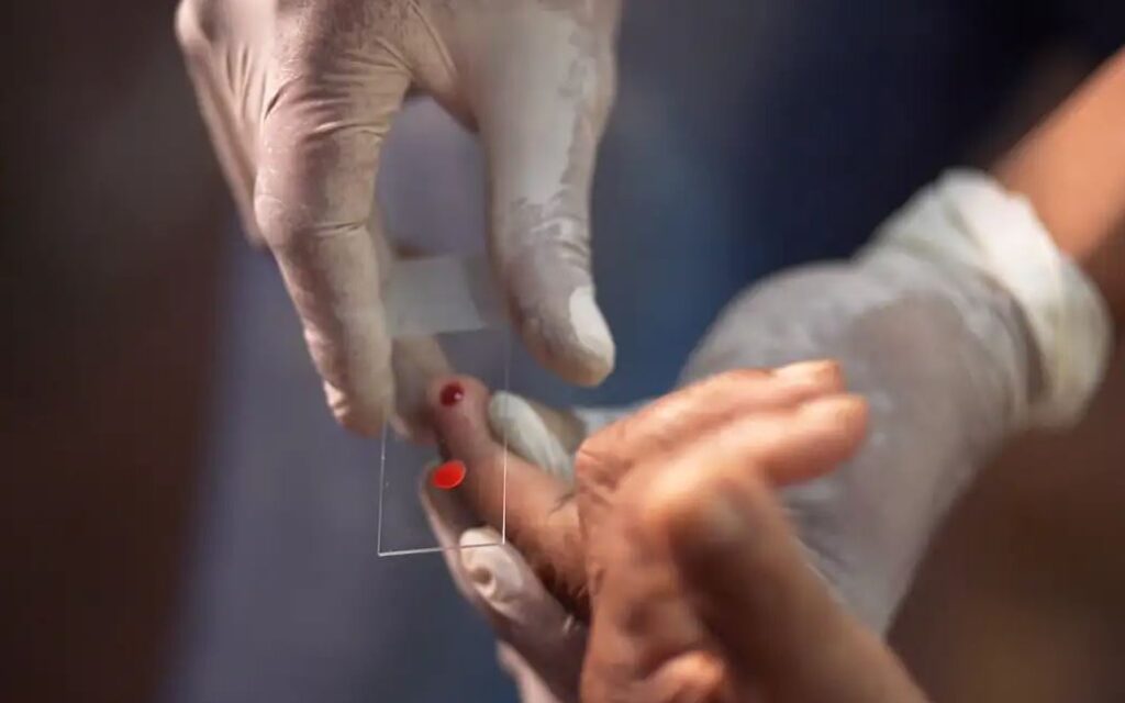 SUS começa a usar novo tratamento contra a malária em crianças