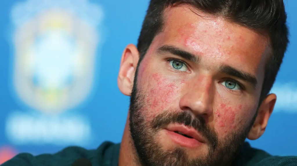 Dermatologista explica doença revelada pelo goleiro Alisson Becker