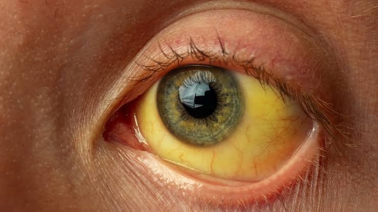 Saúde de Goiânia intensifica combate às hepatites virais durante ‘Julho Amarelo’