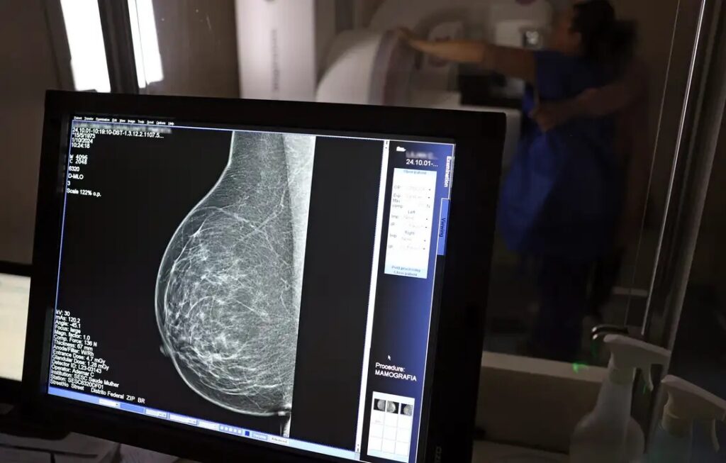 Plano de saúde terá que cobrir mamografia digital para todas as idades